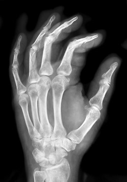 hand x ray